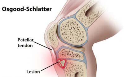 4 Management Strategies for Osgood-Schlatter’s Disease