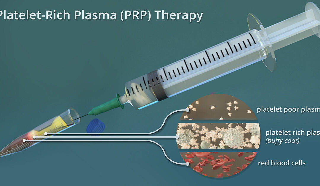 What is Platelet Rich Plasma (PRP) Therapy?