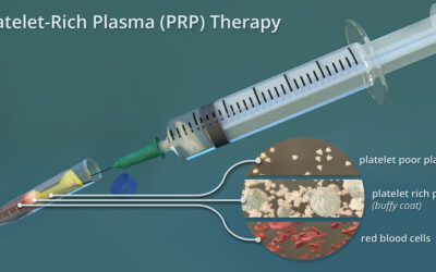 What is Platelet Rich Plasma (PRP) Therapy?