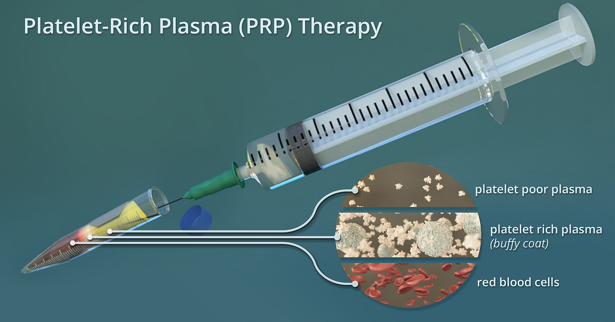 What is Platelet Rich Plasma (PRP) Therapy?